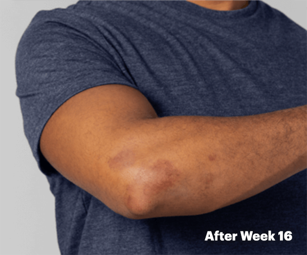 Illustration of patient with clear skin on elbow after Week 16