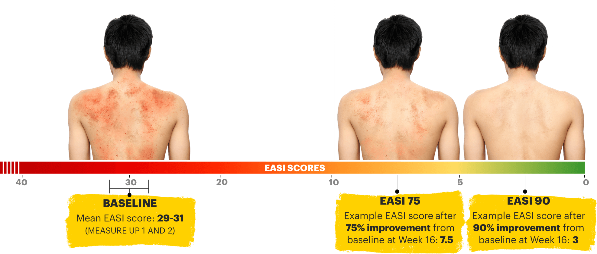 Graph showing difference between baseline, EASI 75, and EASI 90.