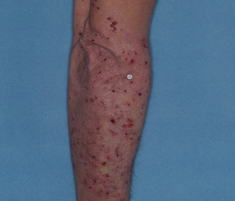 Arms before the treatment.