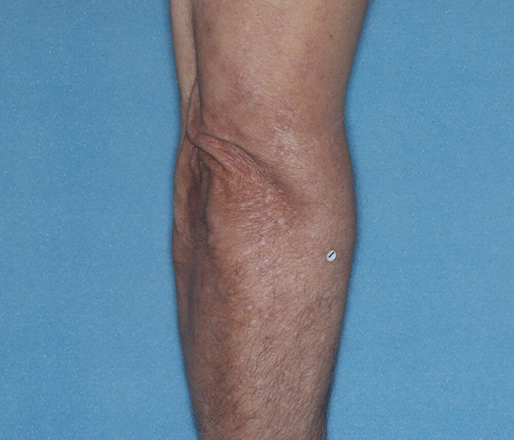 Arms after the treatment at 16 weeks.