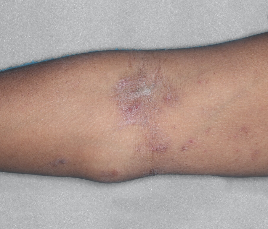 Arms before the treatment.