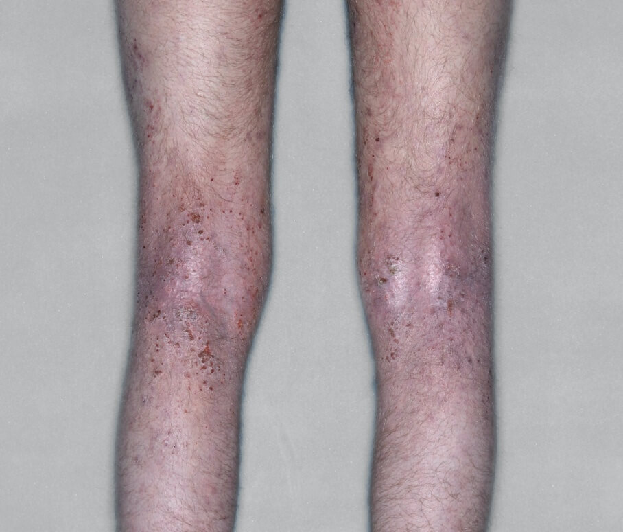 Adult legs before and after.