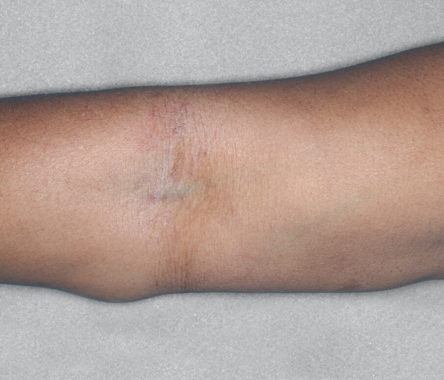 Arms after the treatment at 16 weeks.