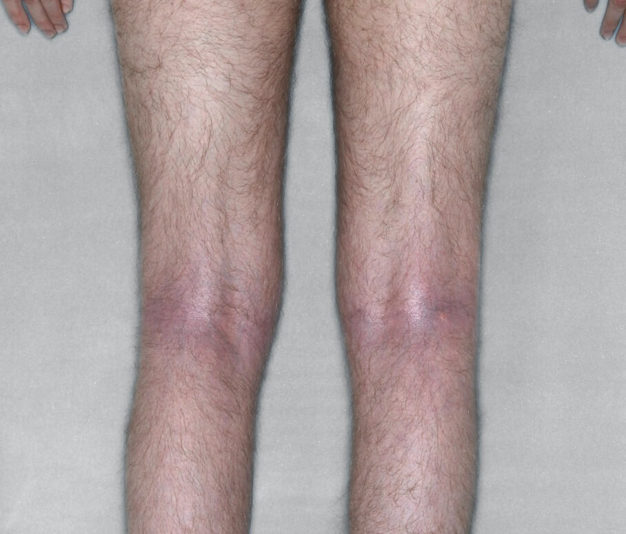 Adult legs before and after.