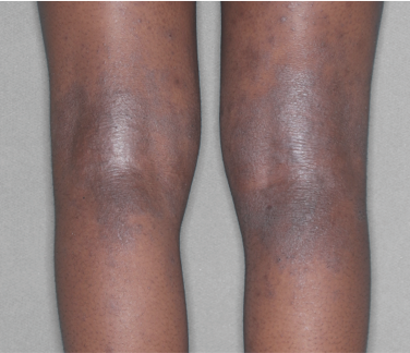 Pediatric legs before and after.