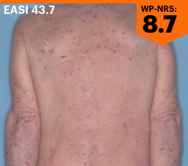 Image showing baseline atopic dermatitis on a patient's back. EASI: 43.7. WP‐NRS 8.7.