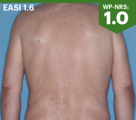 Image showing Week 16 skin clearance and itch relief on a patient's back. EASI: 1.6. WP‐ NRS 1.0.
