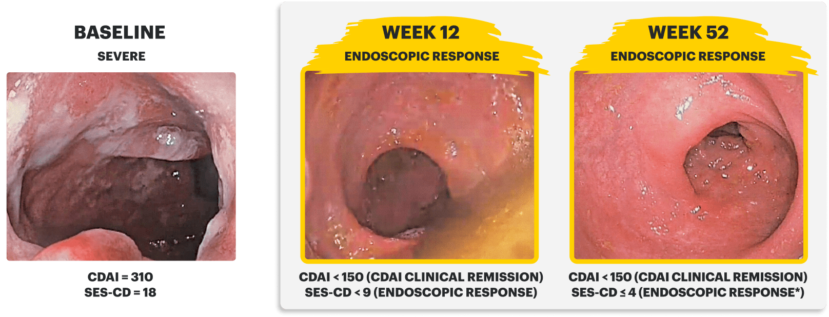 Endoscopy images of a clinical trial patient at baseline (Week 0), Induction (Week 12), and Maintenance (Week 52)