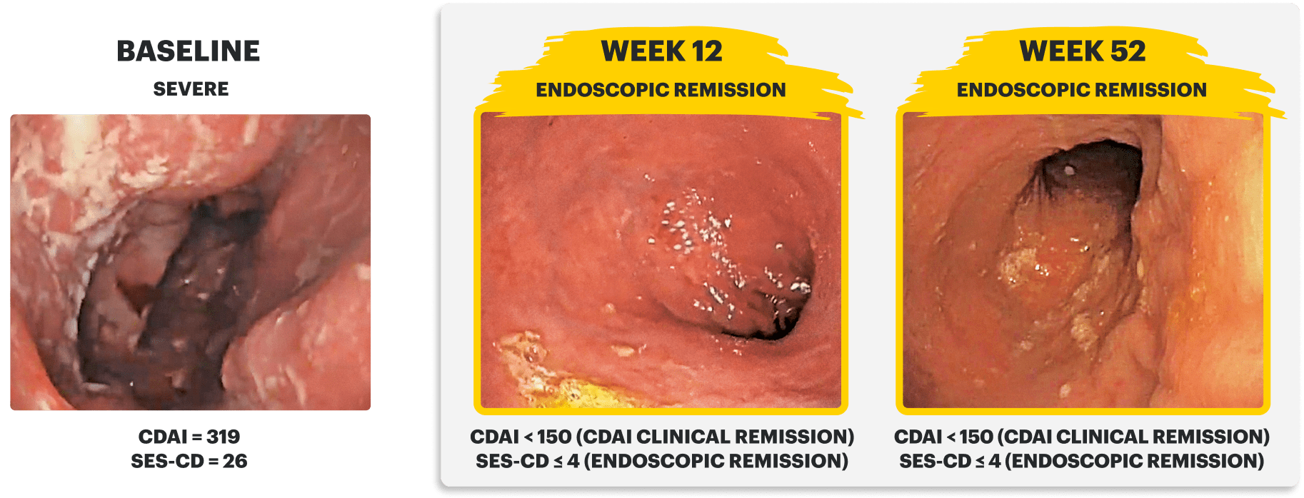 Endoscopy images of a clinical trial patient at baseline (Week 0), Induction (Week 12), and Maintenance (Week 52)