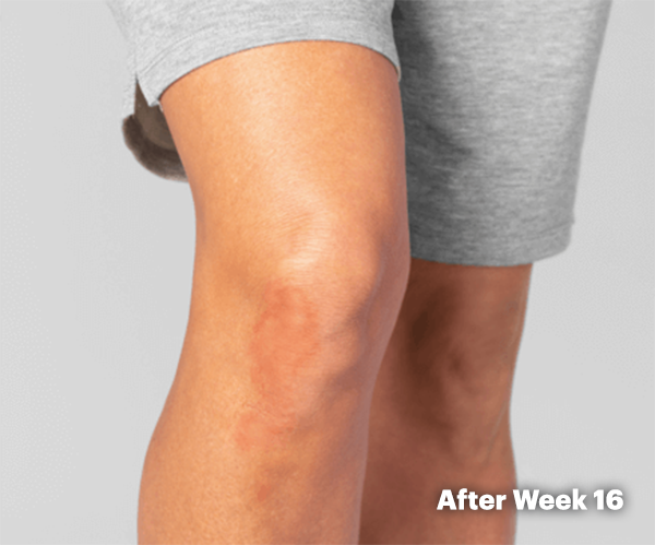 Illustration of patient with clear skin on knee after Week 16