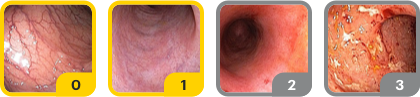 Four endoscopic images show changes in mucosal appearance, ranging from Mayo endoscopy subscore of 0, which is normal; 1, which is mild; 2, which is moderate; and 3, which is severe.